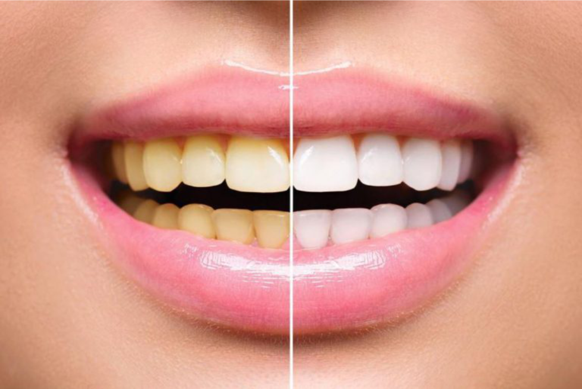 Botsing Luxe Dubbelzinnigheid Wat is tanden bleken? - Witte Tanden Center